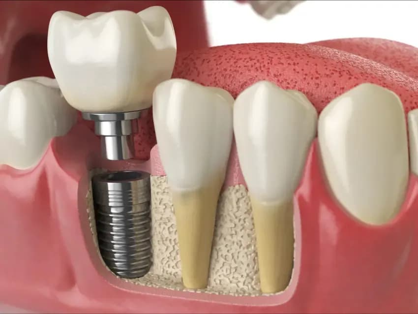 Implant dentar la clinica Elmadenta