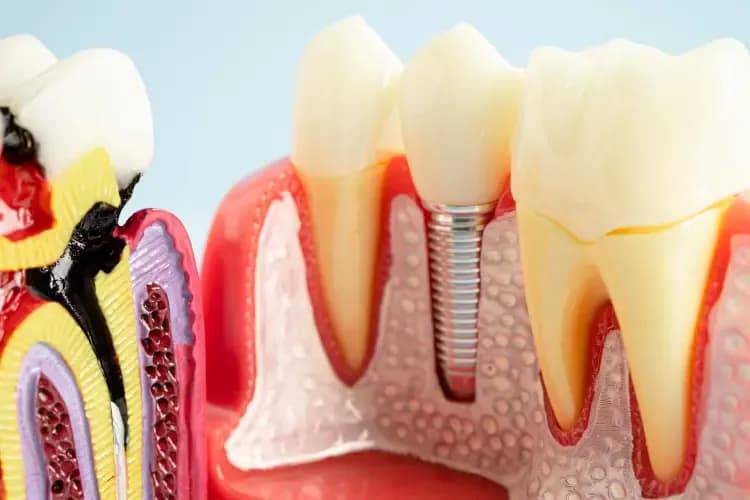 Implant dentar la clinica Elmadenta