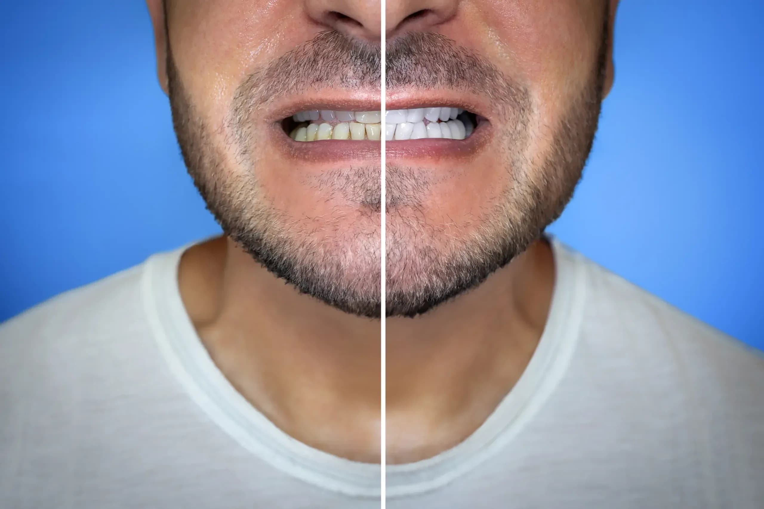 Igienizare dentară la clinica Elmadenta
