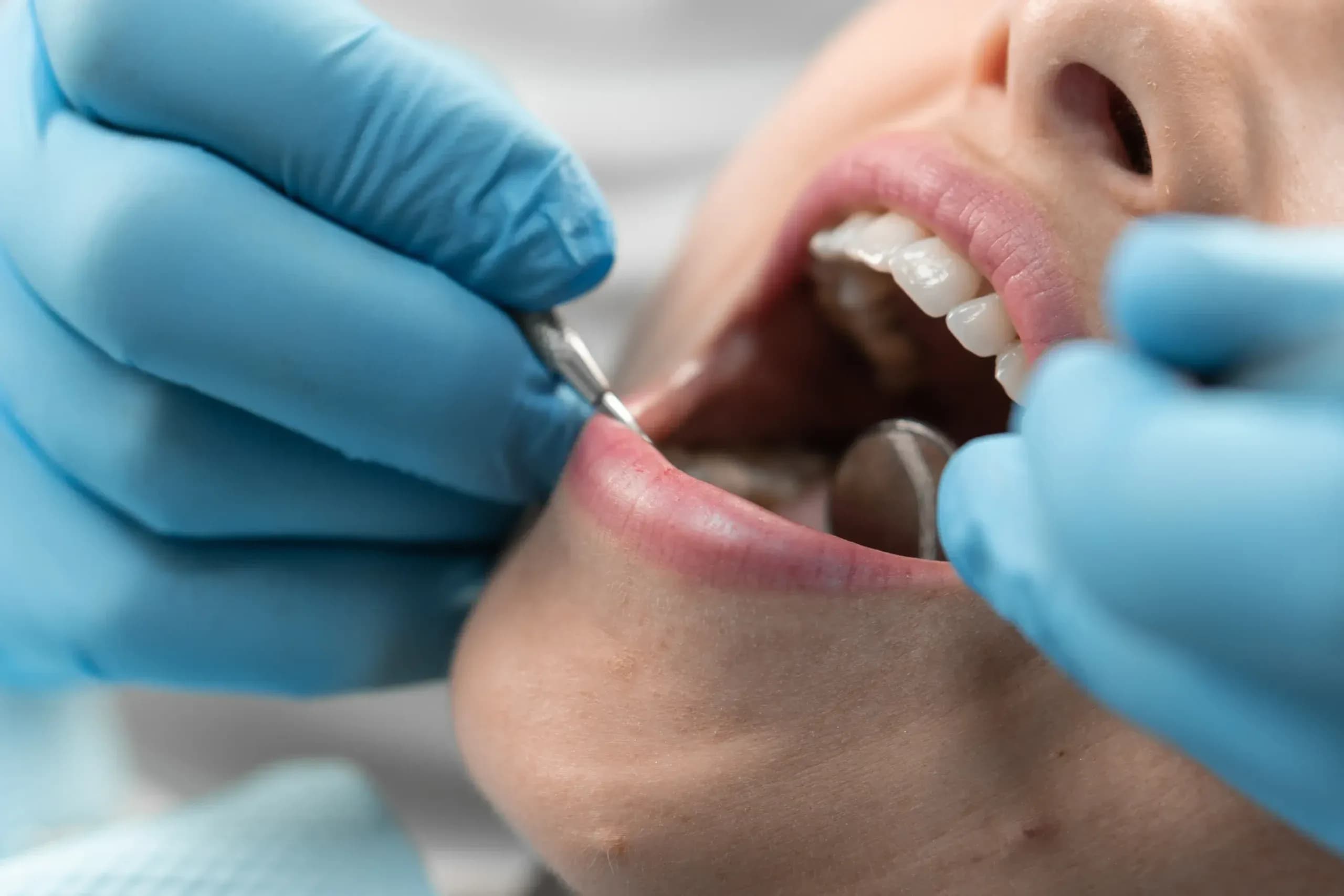 Igienizare dentară la clinica Elmadenta