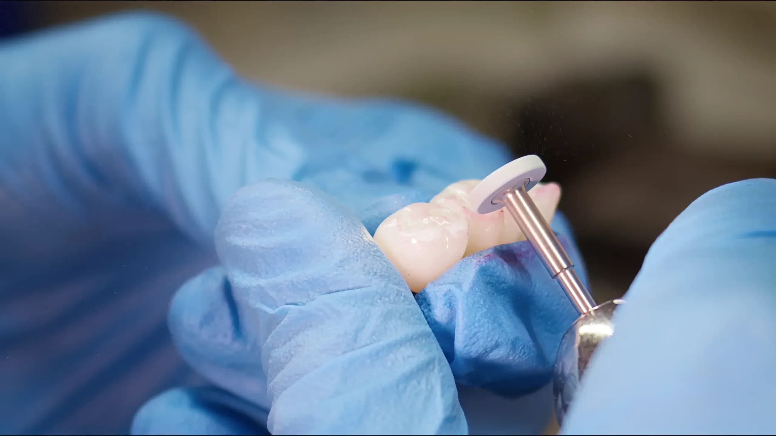 Implant dentar la clinica Elmadenta