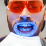 Albirea dentară profesională